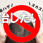 分け目はげを治したい!女性の薄毛種類・対策・改善方法・注意点など
