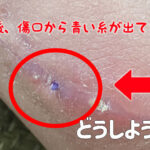手術後の傷跡から青い縫合糸が出てきた!対処法や経過など(体験談)