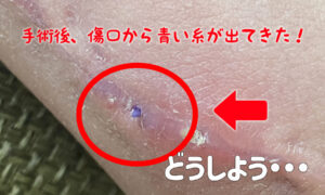 手術後の傷跡から青い縫合糸が出てきた!対処法や経過など(体験談)